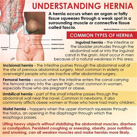 Hernia Inguinalis Adalah: Apa Itu Dan Bagaimana Cara Mengatasinya?