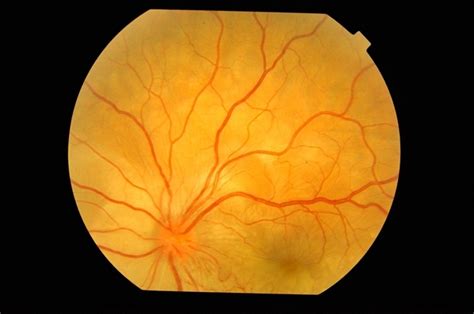 Multifocal Choroiditis - Retina Image Bank