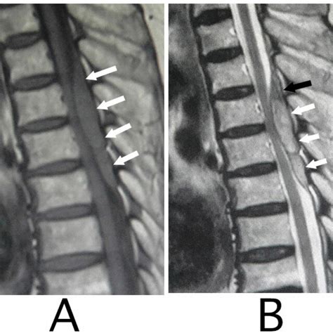 Sagittal MRI. An iso-intensity mass in the epidural space was shown ...