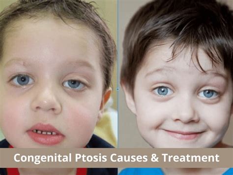 Congenital Ptosis (Drooping Eyelid) Causes & Treatment - Eyezcure