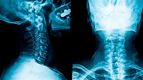 "Understanding Neck X-Ray: What You Need to Know" | Scarborough Radiologists