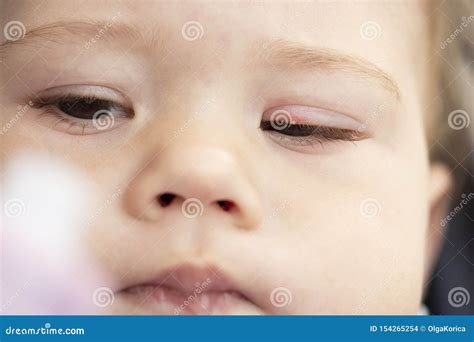 White Pimple on the Eyelid of a Small Child Close-up. Inflammation of ...