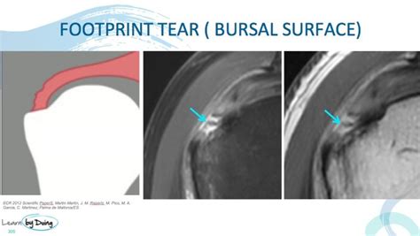 MRI Shoulder Rotator Cuff Footprint Tears - Radedasia