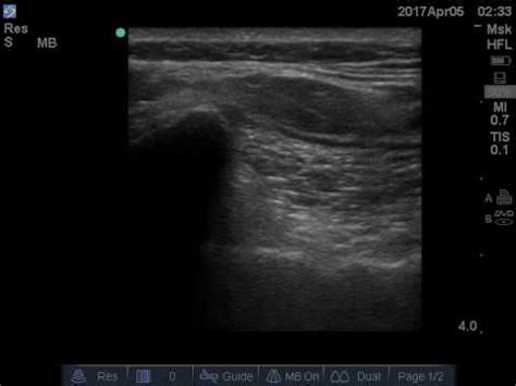 Ultrasound Sacroiliac Joint Injection