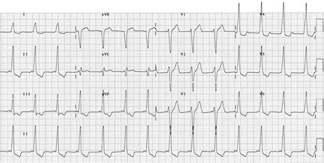 Pre-excitation syndromes • LITFL • ECG Library Diagnosis