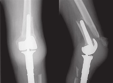 Radiographs of the femur (periprosthetic fracture) | Download ...