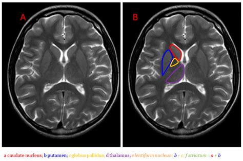 Basal Ganglia Lesions Basal Ganglia Mri Brain Brain Anatomy | Images ...