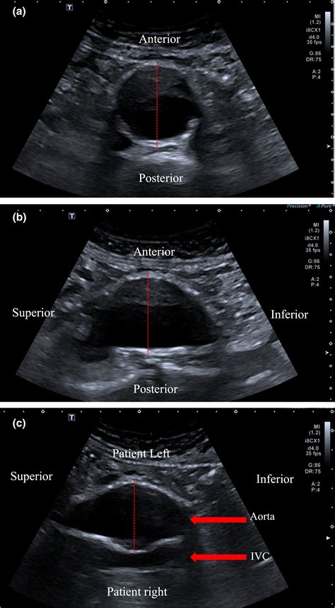 Abdominal Aortic Aneurysm Ultrasound