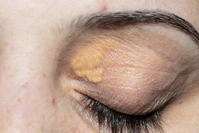 Xanthelasma on the eyelid - Stock Image - C011/9529 - Science Photo Library