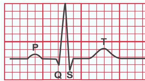 Normal Ecg Vs Heart Attack Ecg