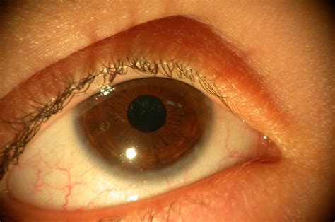 Vernal keratoconjunctivitis (VKC) | www.ocular-surface.org