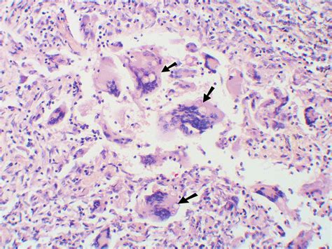 Blastomycosis-blastomycosis symptoms-blastomycosis treatment-blastomycosis diagnosis