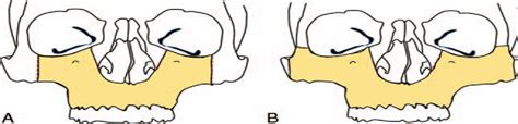 Mid-Face Degloving: An Alternate Approach to Extended Osteot ...