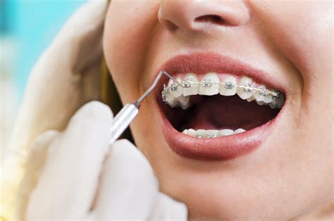 All About Glue And Braces - Reddick Orthodontics Educational