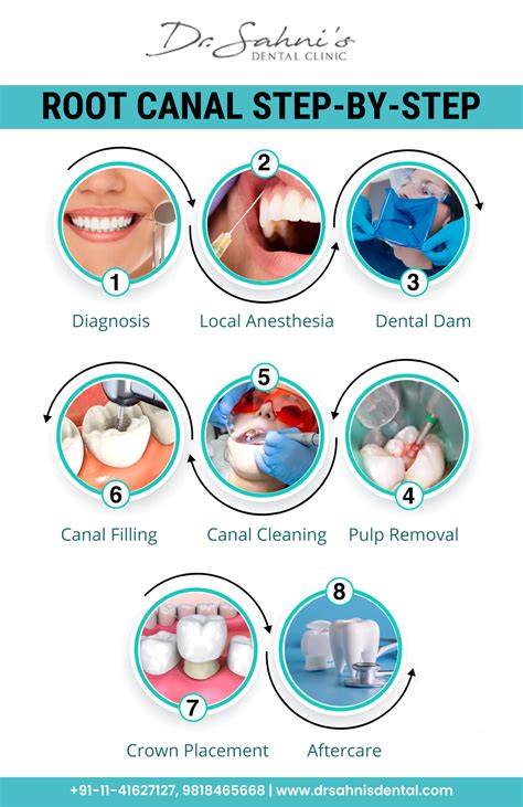 Myths and Facts about Root Canal Treatment | Dr Sahni's Dental Clinic