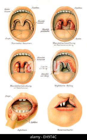 Mouth ulcer Stock Photo - Alamy