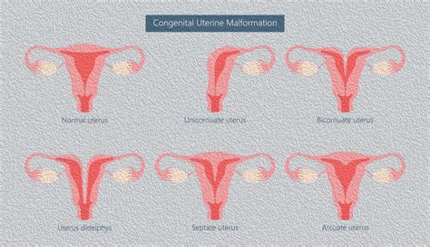 Unicornuate Uterus - Dr Eleftherios Meridis