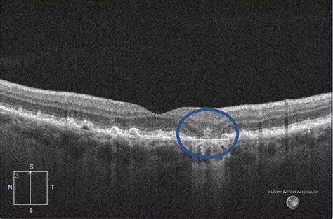 Geographic Atrophy – February, 2023 | Illinois Retina Associates™: Top Retina Specialists in ...