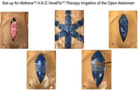 Abthera Wound Vac