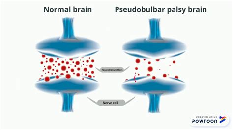 Joker - Pseudobulbar Palsy (part 1) - YouTube