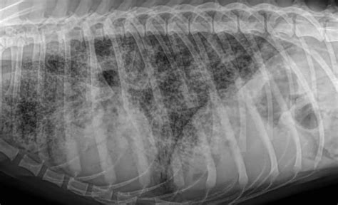 Blastomycosis Lung X Ray