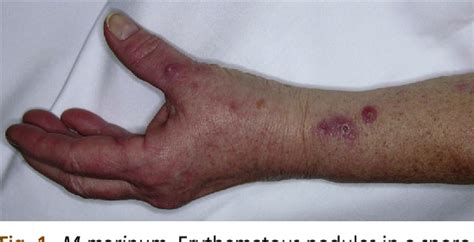 Nontuberculous Mycobacteria: Skin and Soft Tissue Infections. | Semantic Scholar