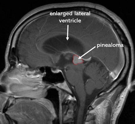 Pineal Gland Calcification