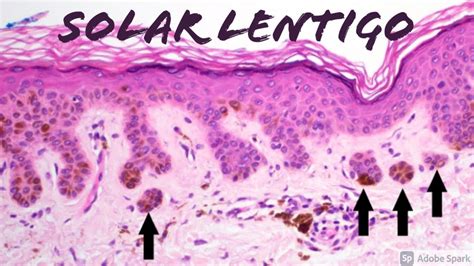 Solar Lentigo (vs Lentigo Maligna Melanoma In Situ on ‪SOX-10‬ Stain): 5-Minute Pathology Pearls ...