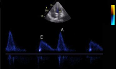 The Echocardiographer's Role In LV Diastology Assessment