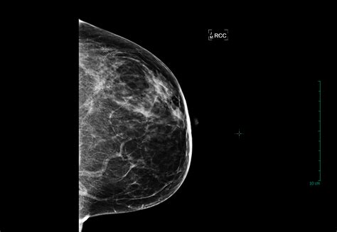 What Breast Density Means to You « Stacey Vitiello, M.D. | Breast ...