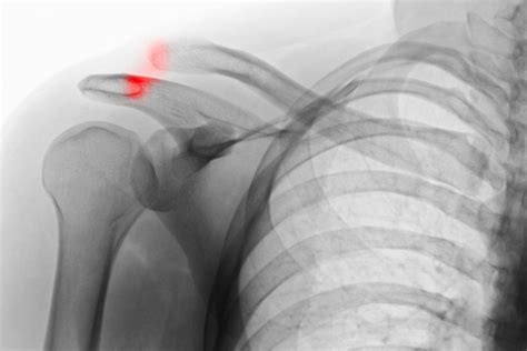 Shoulder Separation Causes, Symptoms and Treatments