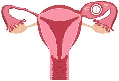 Mirena Removal | What to Expect During & After IUD Removal