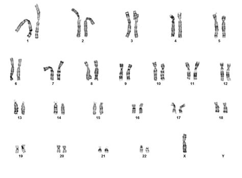 karyotype of turner syndrome - DriverLayer Search Engine