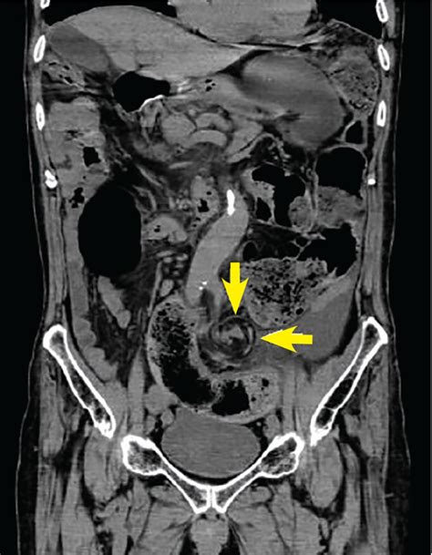 Sigmoid volvulus: Coffee bean sign, whirl sign | Cleveland Clinic ...