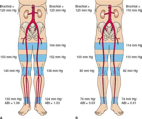 Aortoiliac Disease | Basicmedical Key