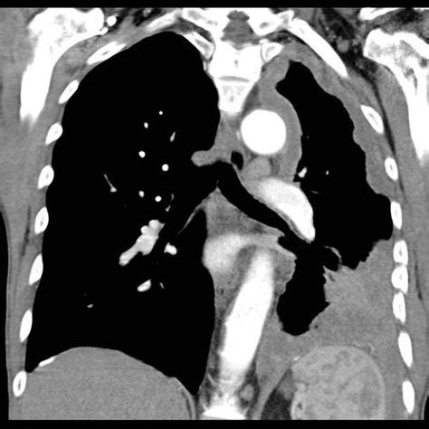 Mesothelioma | Radiology Reference Article | Radiopaedia.org ...