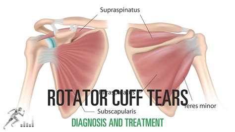 Rotator Cuff Tear Diagram