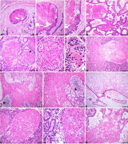 Granular Cell Tumor Histology