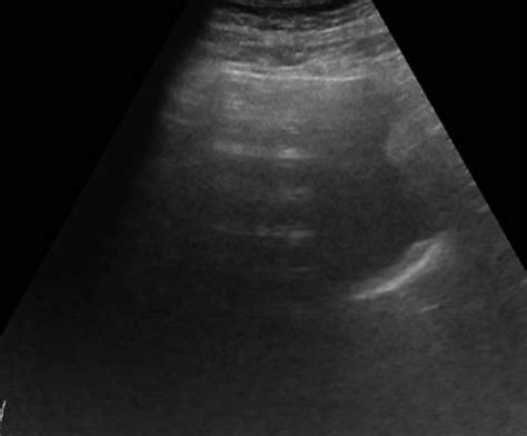 Abdomen and retroperitoneum | 1.1 Liver : Case 1.1.4 Liver cysts ...