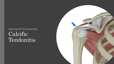 Calcific Tendonitis — learnED