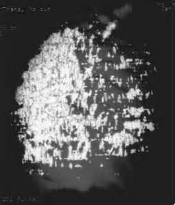 CT Quantification of Emphysema - Computed Tomography