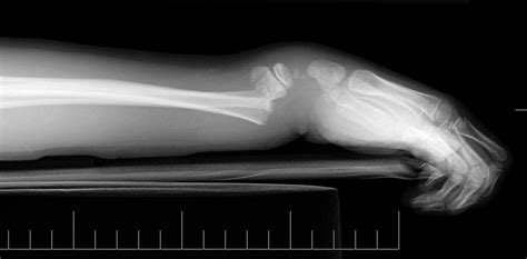 CME 01/12/16 - Colles' Fracture Reduction Techniques - Charlie's ED