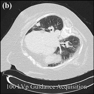 Lung nodule biopsy with low dose CT guidance protocol. Single images... | Download Scientific ...