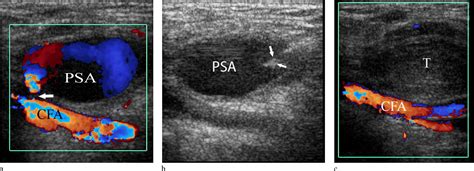 Ultrasound-Guided Thrombin Injection for the Treatment of Femoral ...