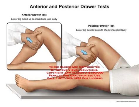 Knee special tests short Flashcards | Quizlet