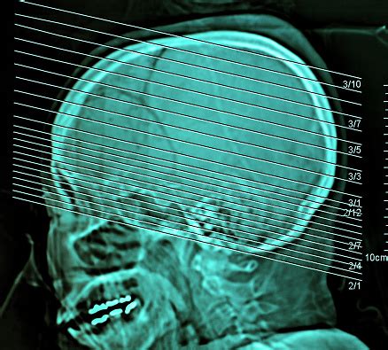 Computerized Film Xray Tomography Of Human Brain Ct Scan Medical Concept Stock Photo - Download ...