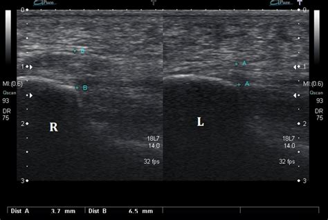 Ultrasound Images of Plantar Fasciitis - Ankle, Foot and Orthotic Centre