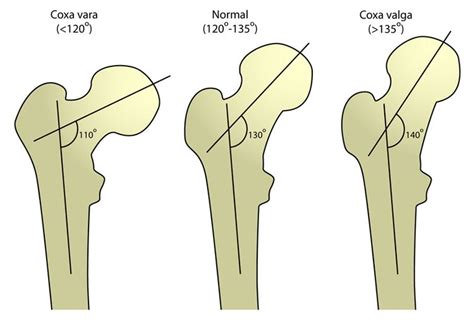 Coxa valga - Alchetron, The Free Social Encyclopedia