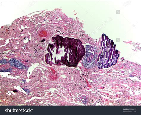 Dystrophic Calcification ( Osteodystrophy). Magnification 40x Stock Photo 70098619 : Shutterstock