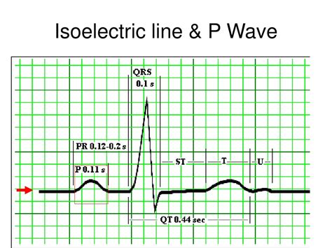 PPT - ECG PowerPoint Presentation, free download - ID:9569601